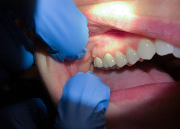 Best Emergency Tooth Extraction in Alto, TX