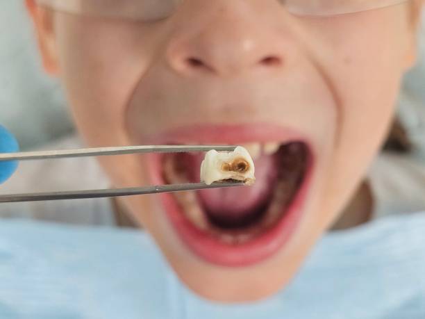 Best Emergency Wisdom Teeth Removal in Alto, TX